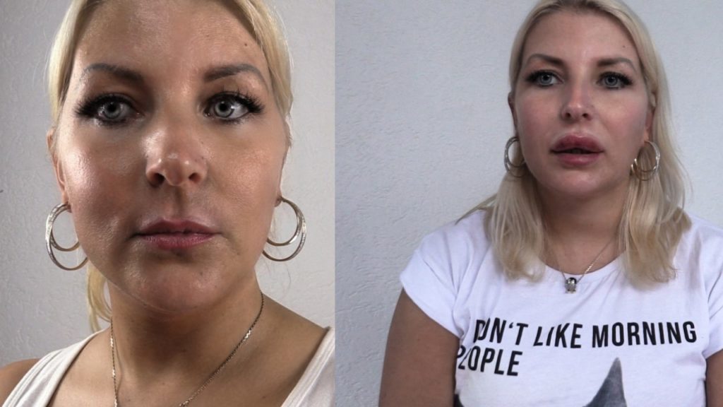 Erfahrungen Lippen aufspritzen mit Hyaluron | Sweet but CEO!