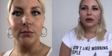 Lippen aufspritzen mit Hyaluron Video vorher nachher