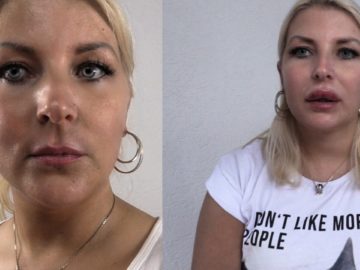 Lippen aufspritzen mit Hyaluron Video vorher nachher